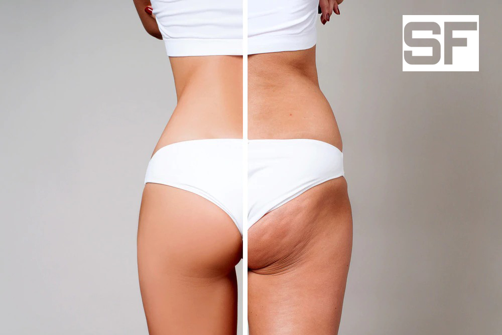 How To Really Get Rid Of Cellulite
